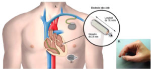 Lee más sobre el artículo Cardiòlegs del Trueta implanten amb èxit el primer desfibril·lador sense cables